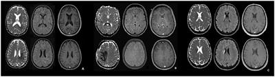 Rebound After Fingolimod and a Single Daclizumab Injection in a Patient Retrospectively Diagnosed With NMO Spectrum Disorder—MRI Apparent Diffusion Coefficient Maps in Differential Diagnosis of Demyelinating CNS Disorders